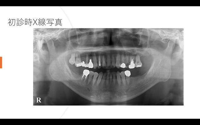 初診時X線写真