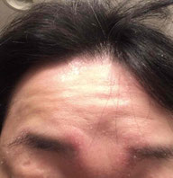 私の今の現状 症状を写真 画像付きで 30代男のゼロから始める脂漏性皮膚炎講座