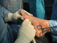 Cirugia del pie en Clínica del Pie Rivera en Murcia