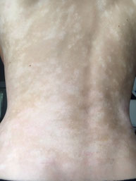 dos avec des taches blanches de depigmentation signe de guerison de l eczema