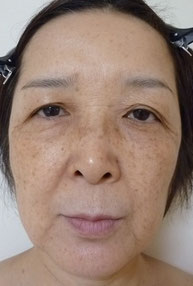 施術前