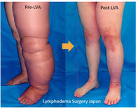 Lymphedema Surgery Japan, Cellulitis, Makoto Mihara