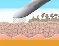Zellabtragung durch Mikrodermabrasion