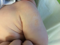 eczema sec etendu