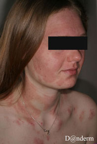 photo de dermatite tête et cou