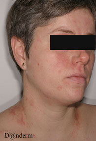 eczema atopique visage