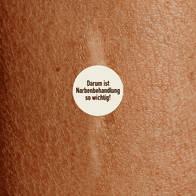 Narbentherapie Basel