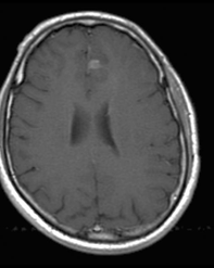 Diffuse astrocytoma C+