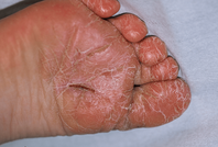 dermatose plantaire juvenile