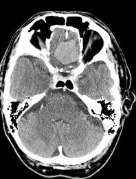 Contrast enhanced meningioma CT