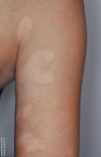 dartres blanches sur le bras d un enfant a peau foncee