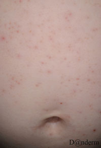 eczema folliculaire