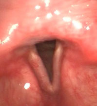 aspetto delle corde vocali a un mese dall'intervento