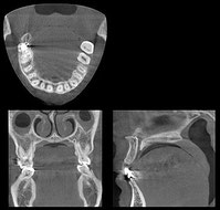 歯科用ＣＴ2