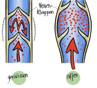 Die Venenklappen... Schwachstellen der Venen