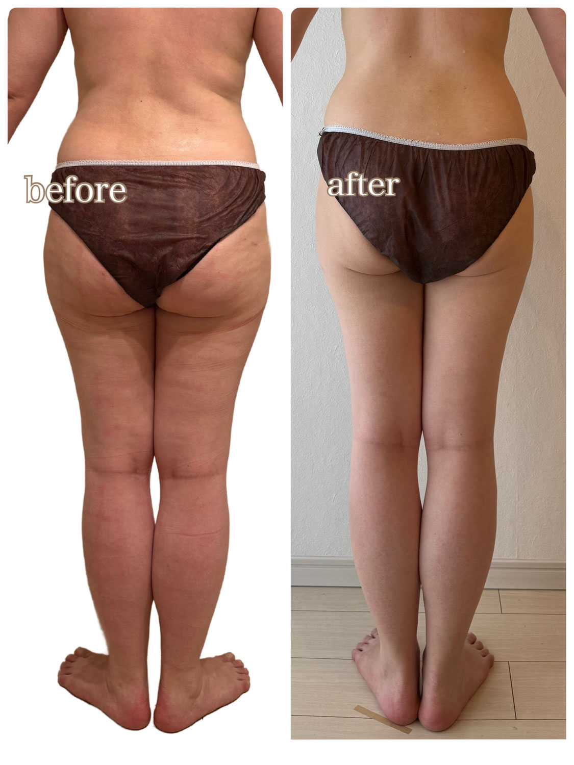 【お客様の変化】悩みの太ももが−12.1cmも細くなって奇跡のようだ！