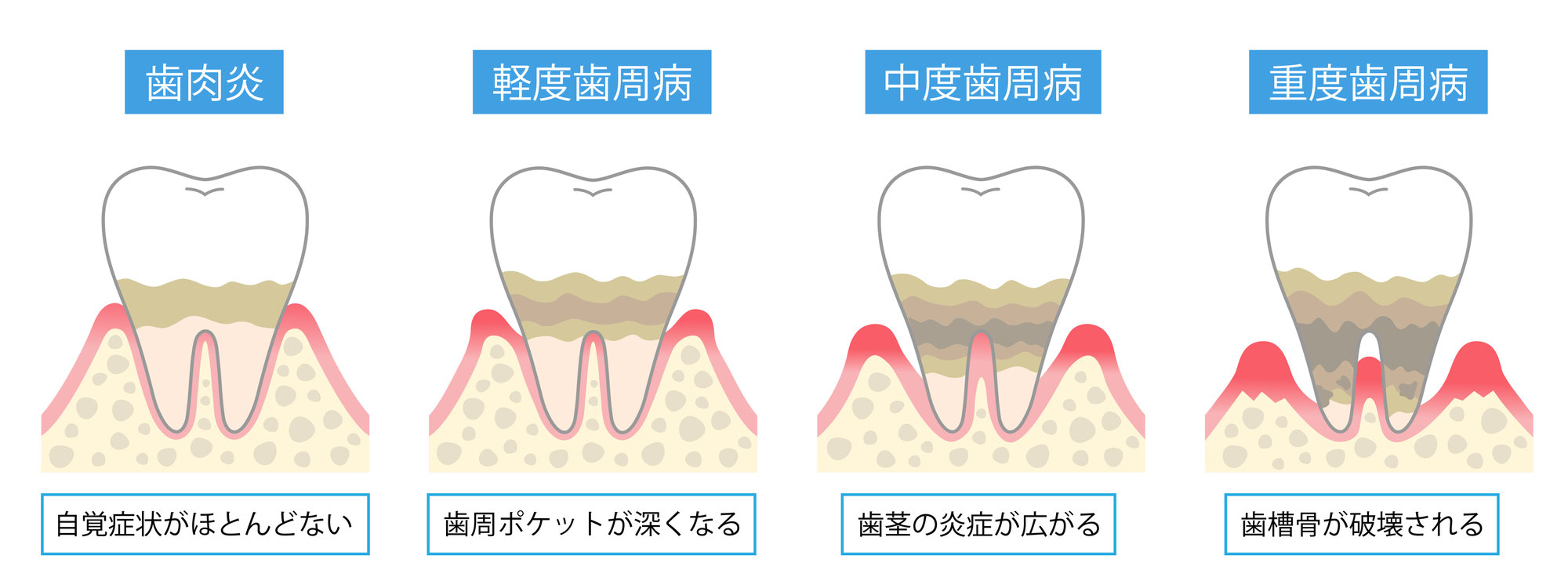 歯周ポケットの名前は知っているけれど…？