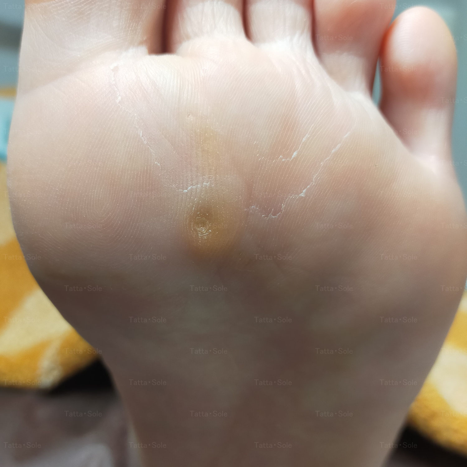 足裏角質　魚の目ケア！