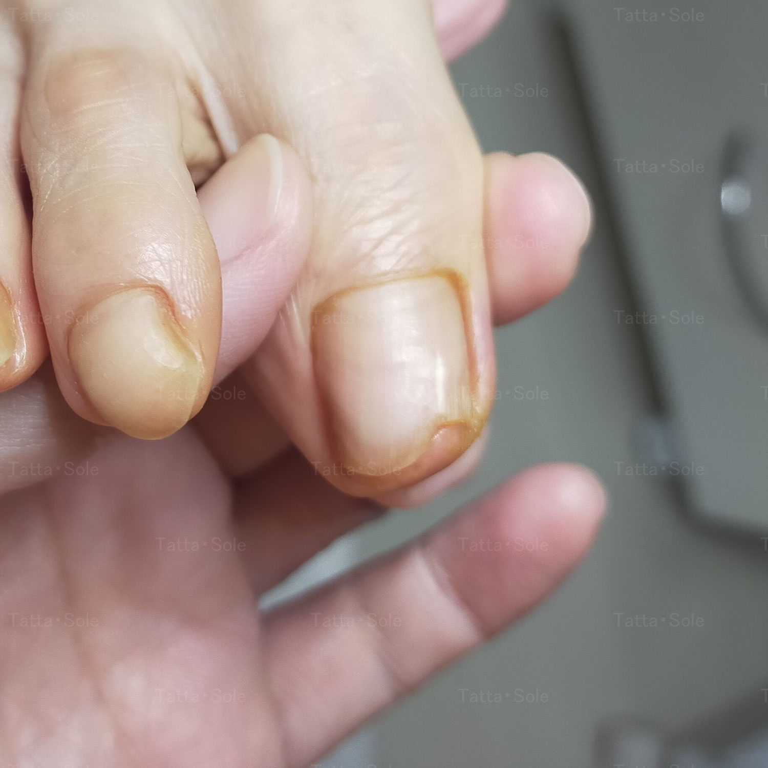 爪が縦に割れた！ネイルはお休みしてケアに専念します　その②