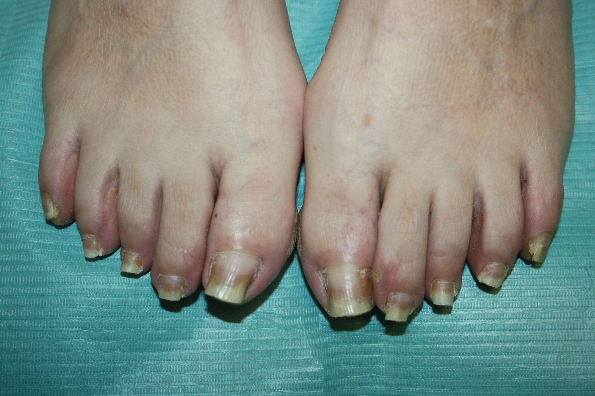 Psoriasis: qué es y cómo afecta a las uñas