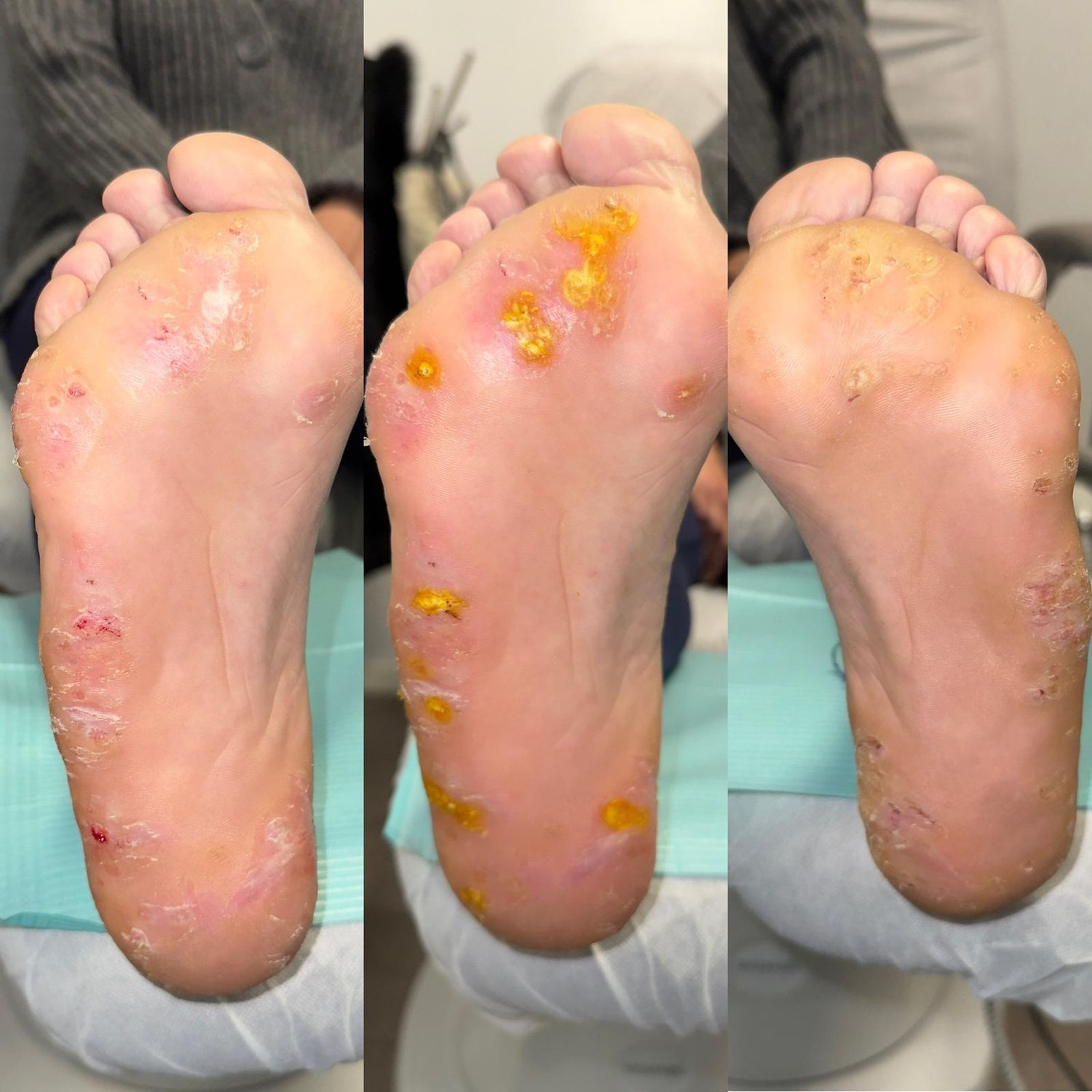 Caso clínico: Verruga plantar en mosaico resistente (Bilateral)