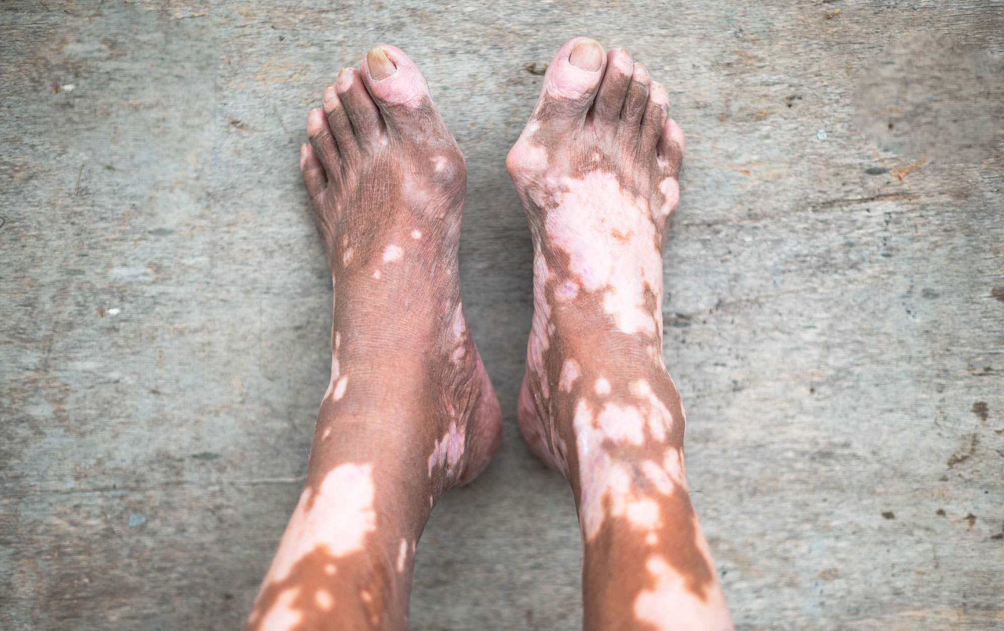 Vitiligo: Una revisión sobre la afección de la piel.