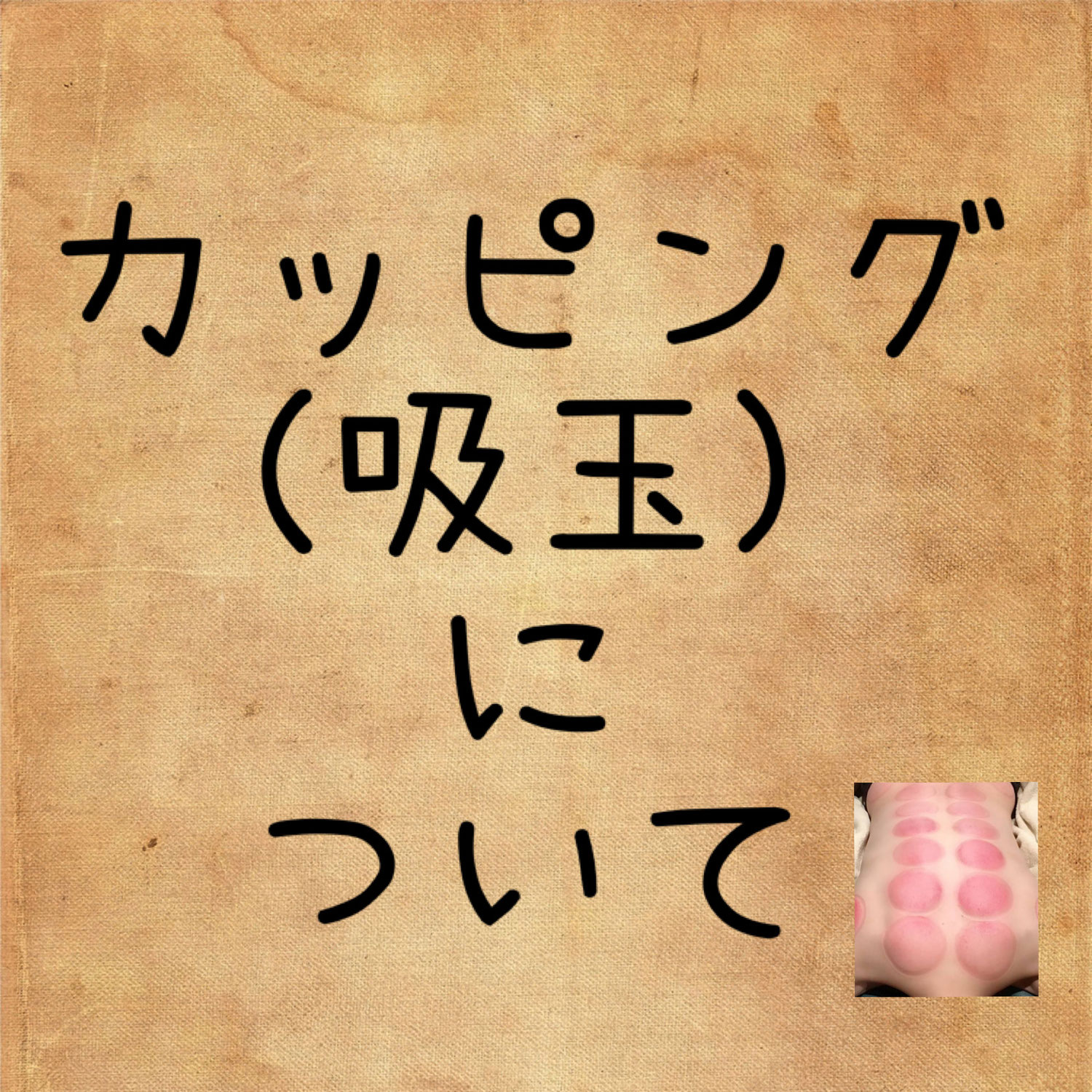 『カッピング（吸玉）』で体質改善へ