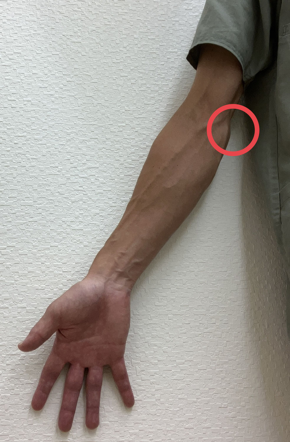 ゴルフしないのに『ゴルフ肘』の謎