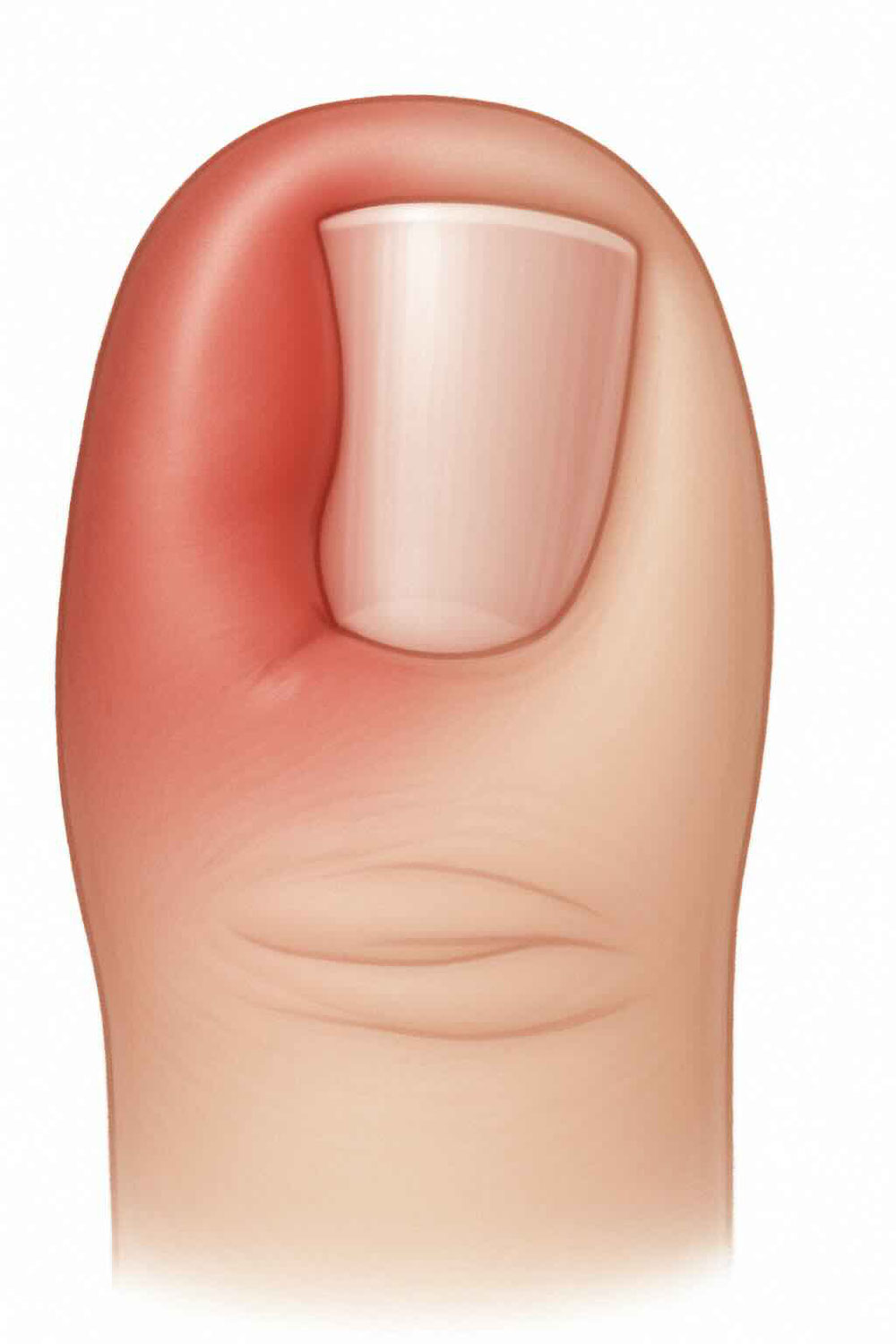 Eingewachsener Zehennagel (Unguis incarnatus): Ursachen, Behandlung & moderne Therapien
