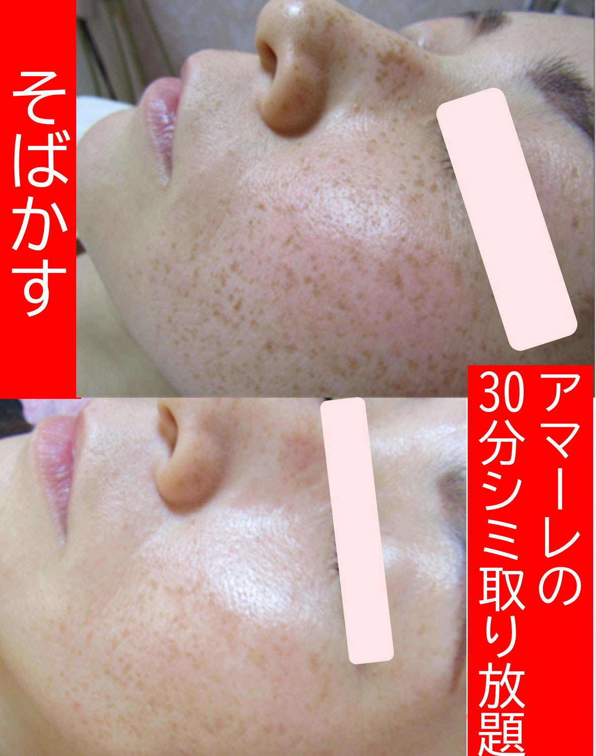 そばかすでお悩みの方へ。鏡を見るのが　楽しみになる肌作り