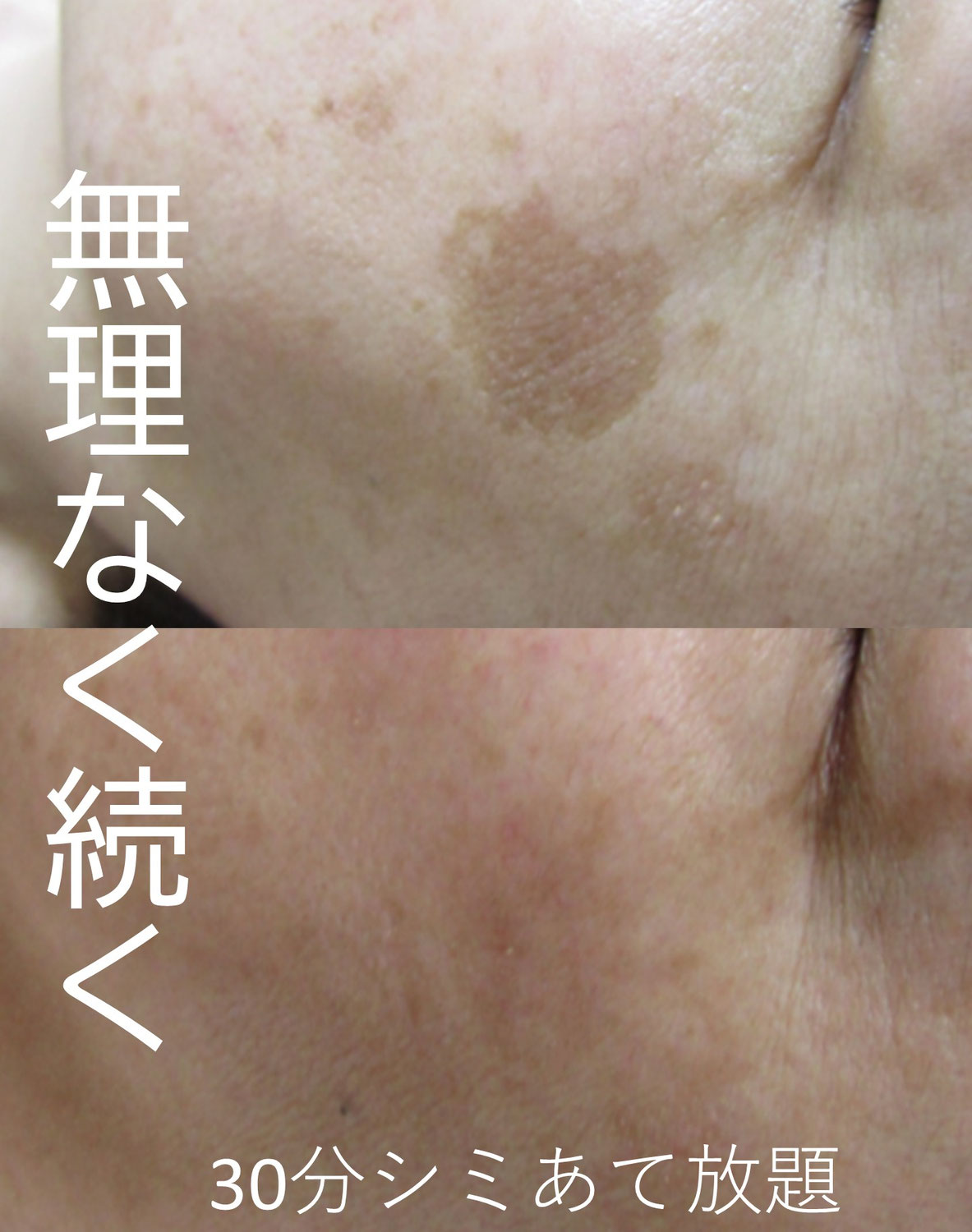 頬のシミ気になる方!!