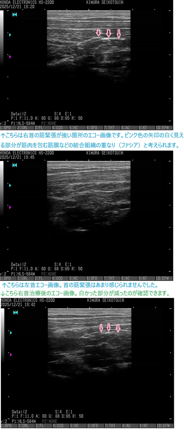 頭痛を伴う首の痛み➡超音波検査