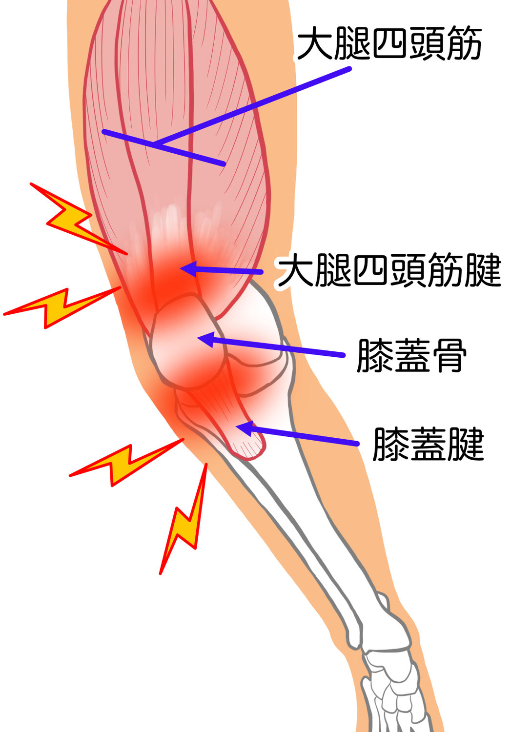 膝蓋腱炎（ジャンパー膝）