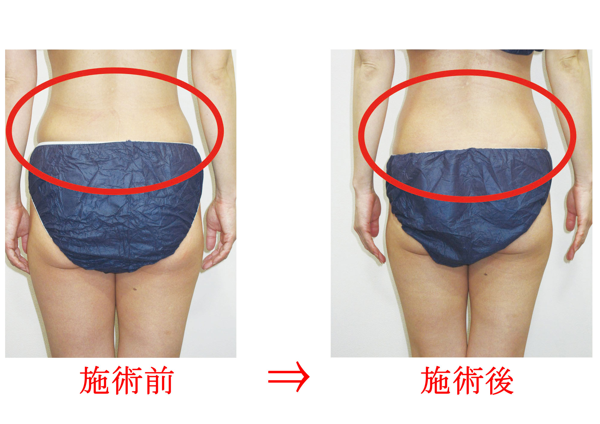 【女性の浮き輪肉】腰周りの「浮き輪肉」を徹底引き締め！骨盤・歪みケア＆最新マシンの専門コース｜東京美容整体 品川院