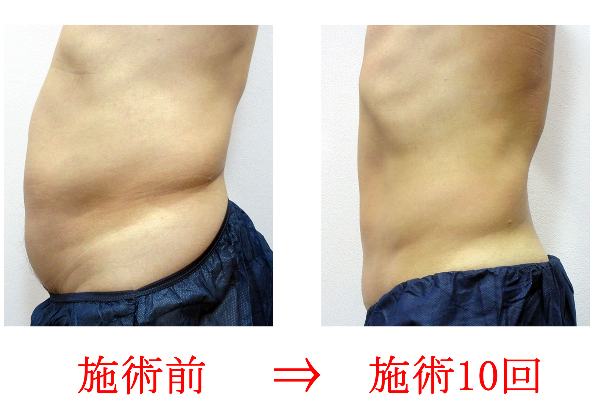 【男性のぽっこりお腹】皮下脂肪を分解して徹底引き締め！反り腰ケア＆最新マシンの専門コース｜東京美容整体 品川院
