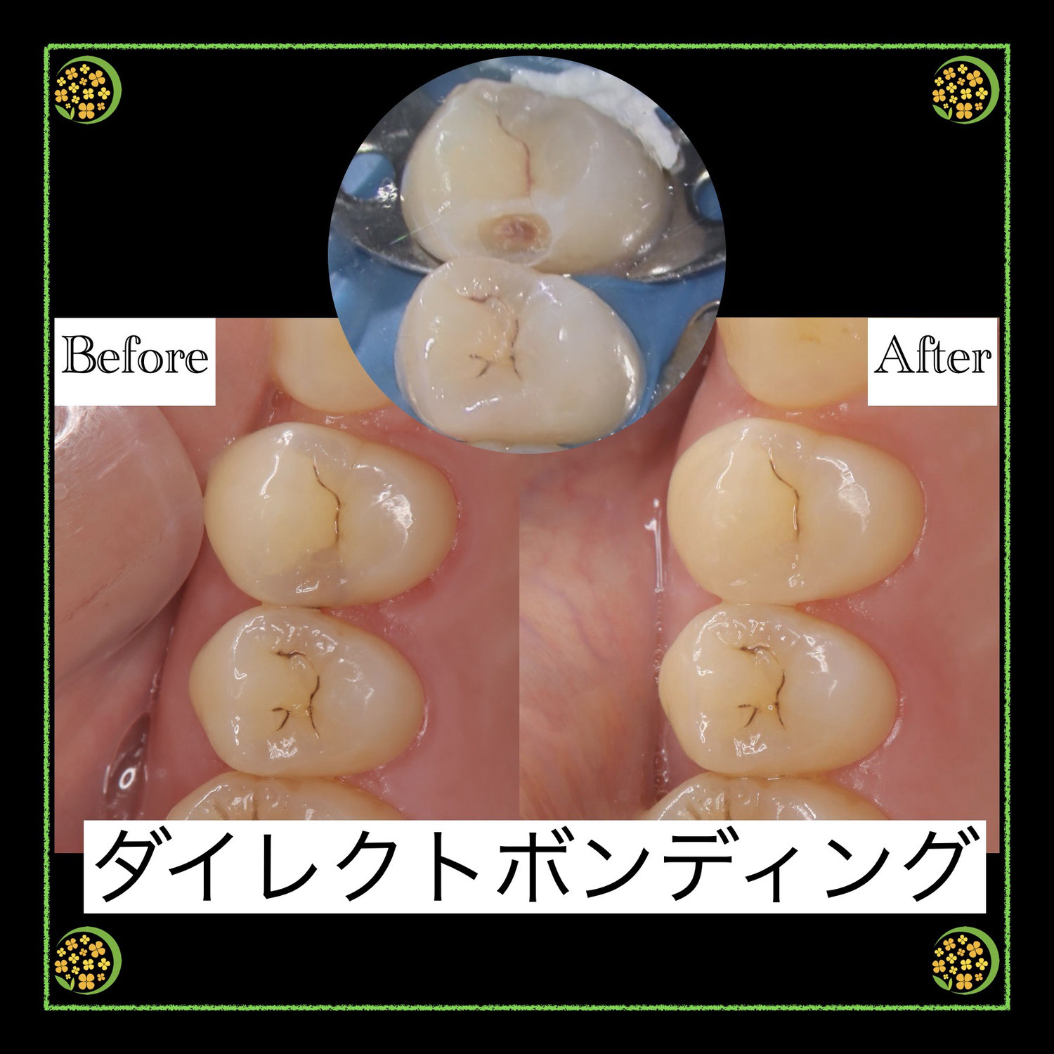 歯の間の虫歯治療【ダイレクトボンディング】