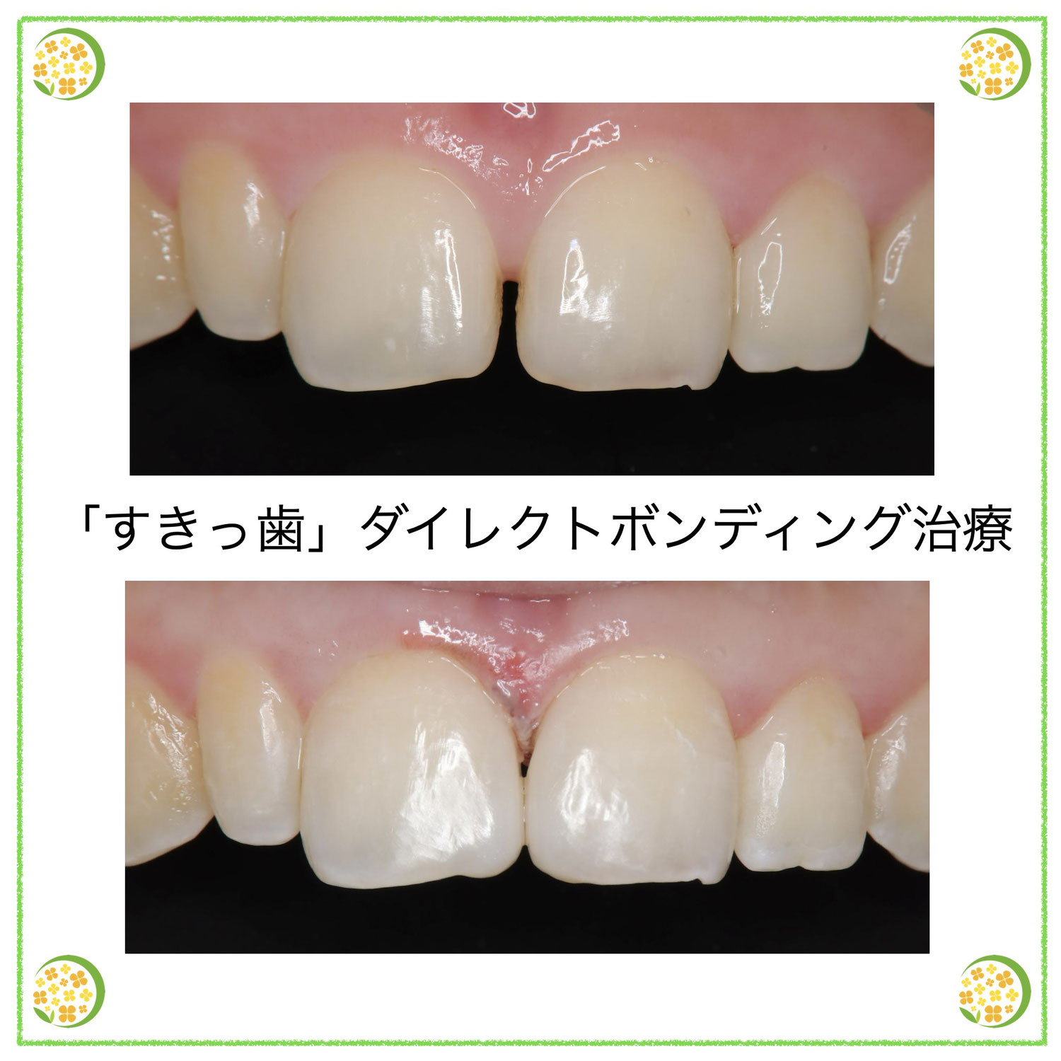 すきっ歯ダイレクトボンディング治療　施術後の注意点