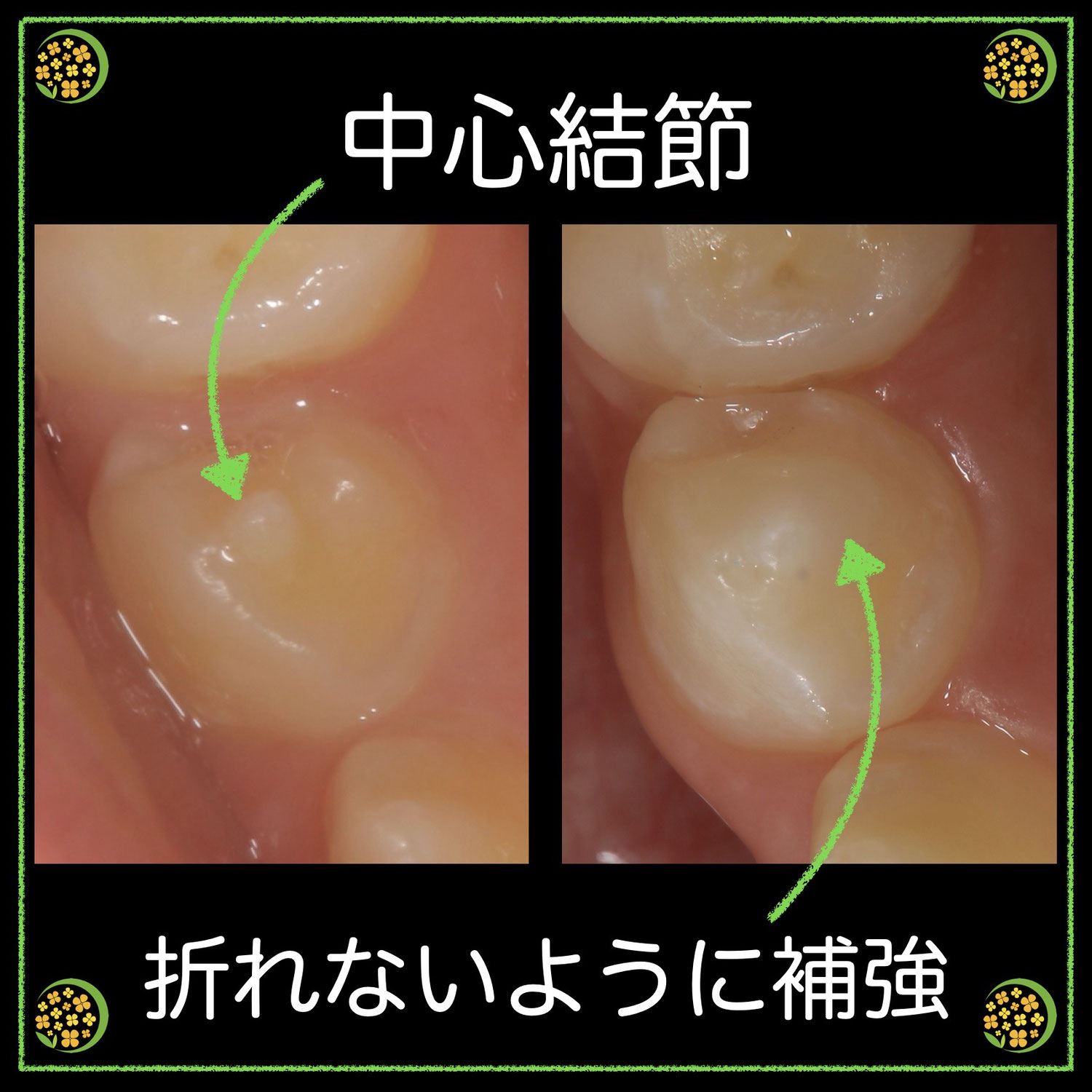中心結節のお話
