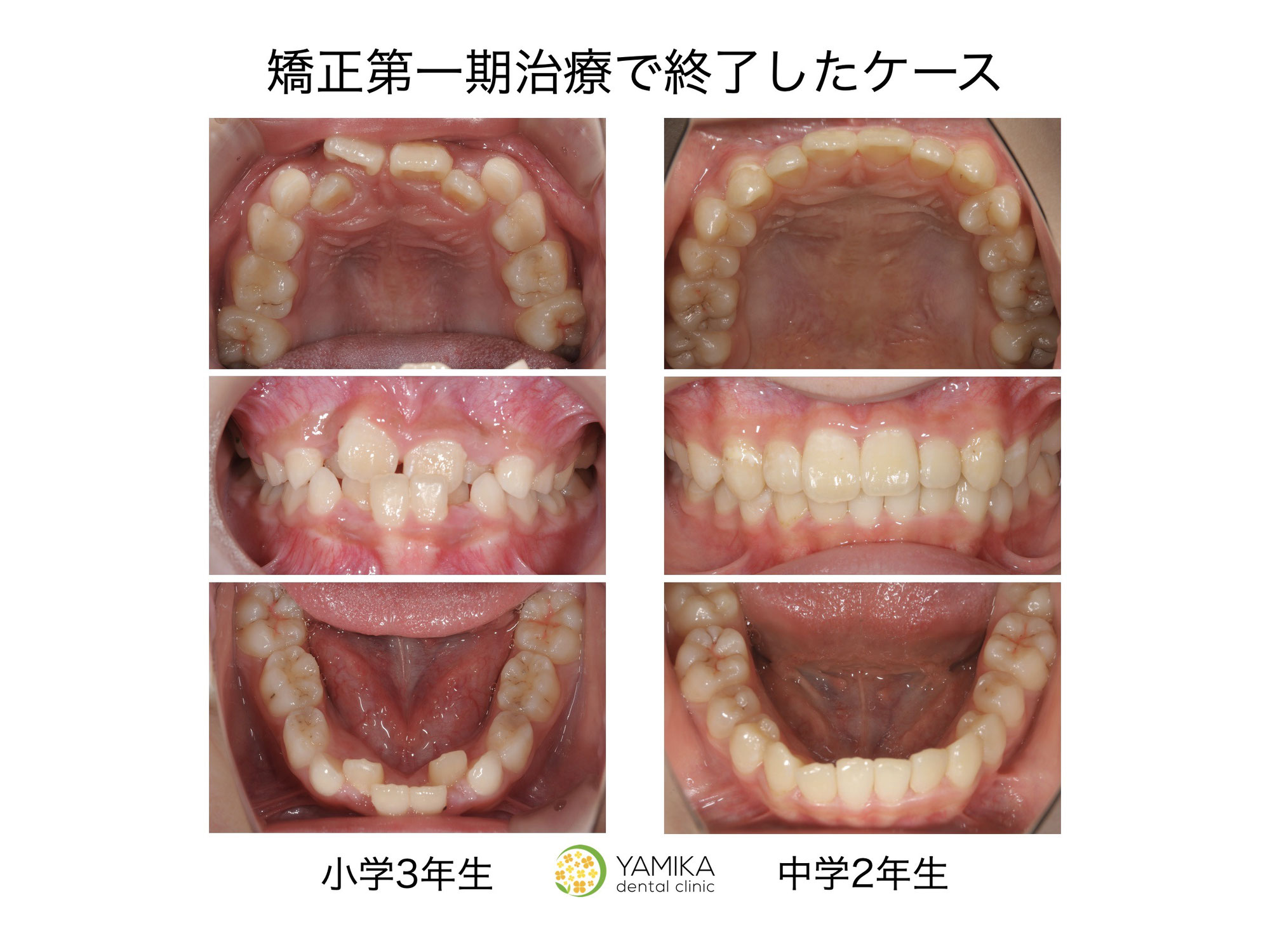 子どもの矯正（第一期治療）だけで終われる？