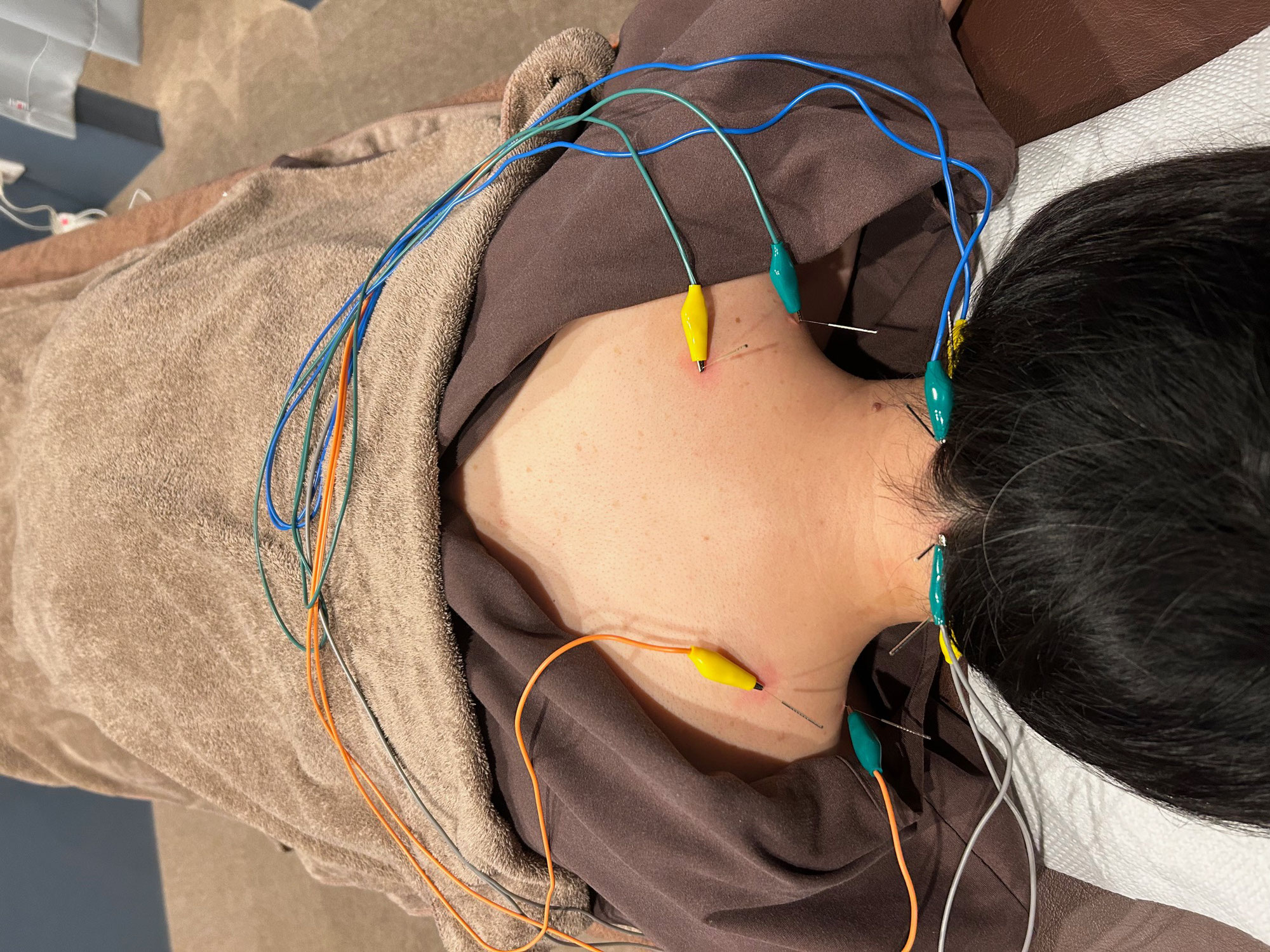 【鍼通電について】