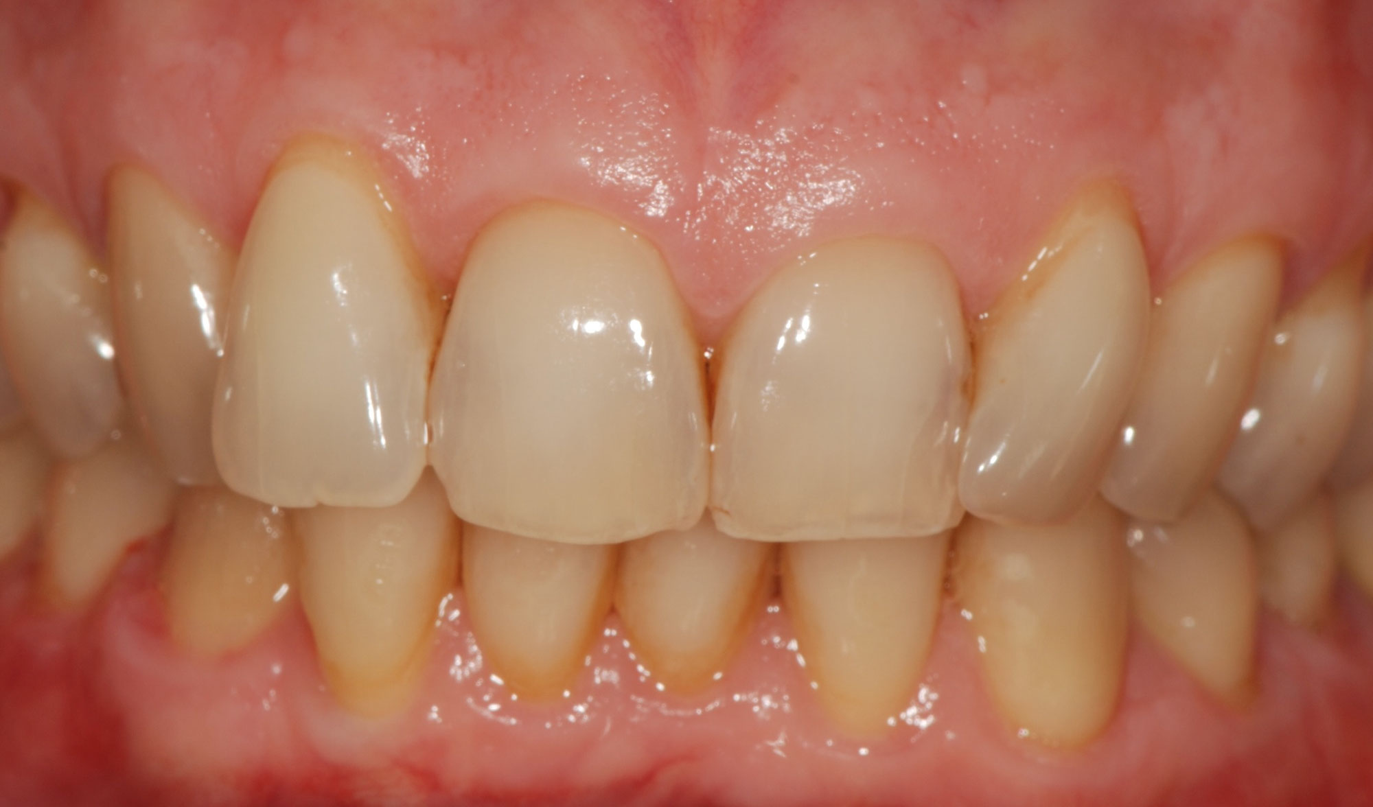 Perchè i denti ingialliscono e come posso prevenirlo?