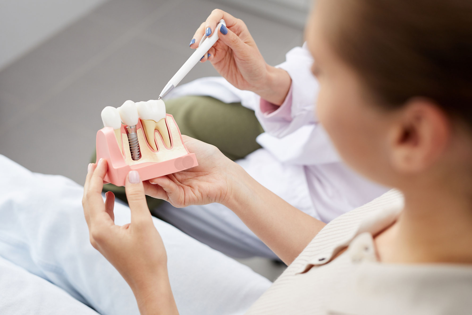 Cosa è un impianto dentale ALL INCLUSIVE?