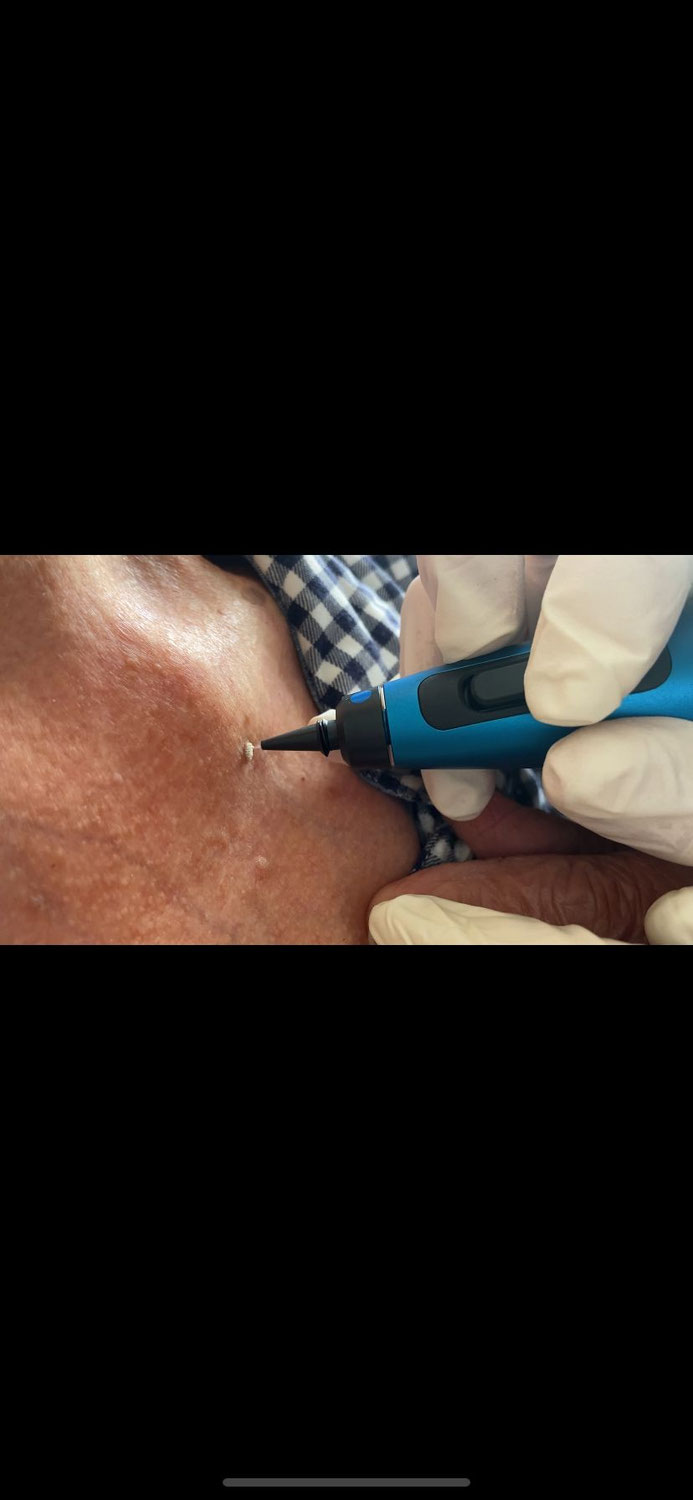 5 redenen waarom de cryo pen de oplossing is voor hand- en voetwratten