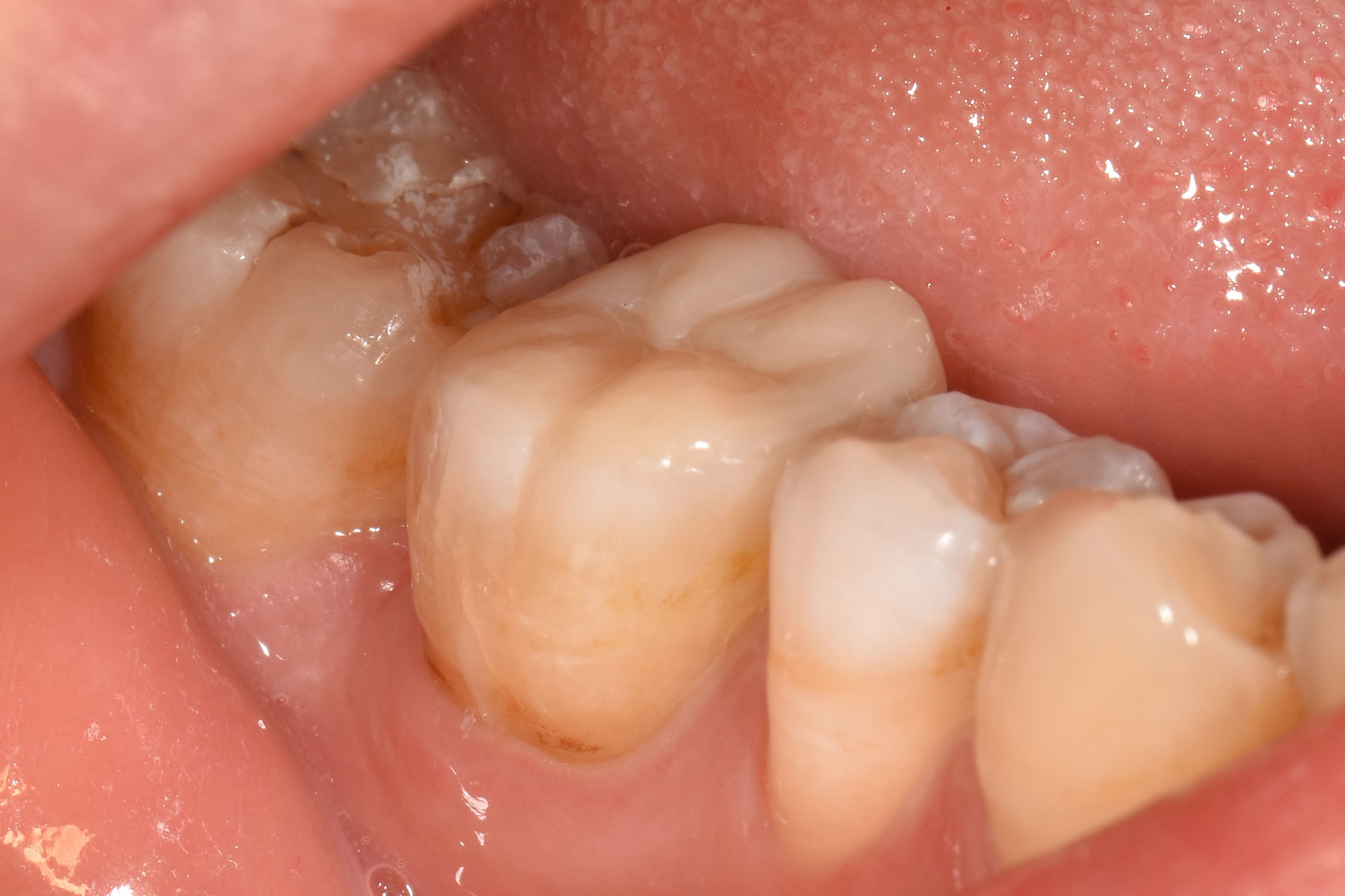 オーバーレイによって健全歯質を大幅に残した症例