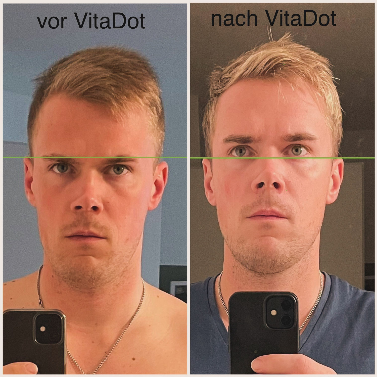 VitaDots vs Beinlängendifferenz