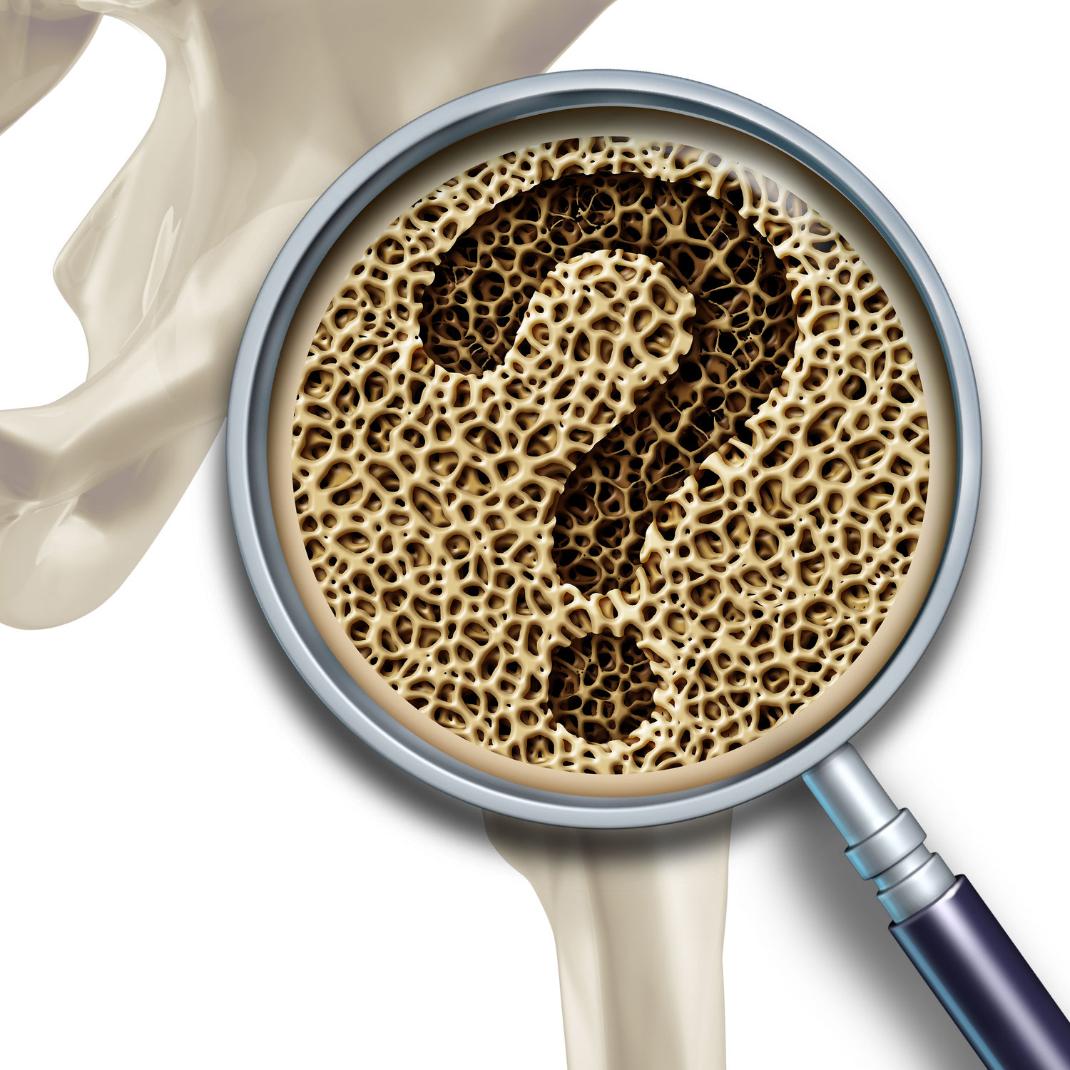 Osteoporosis y Ondas de choque