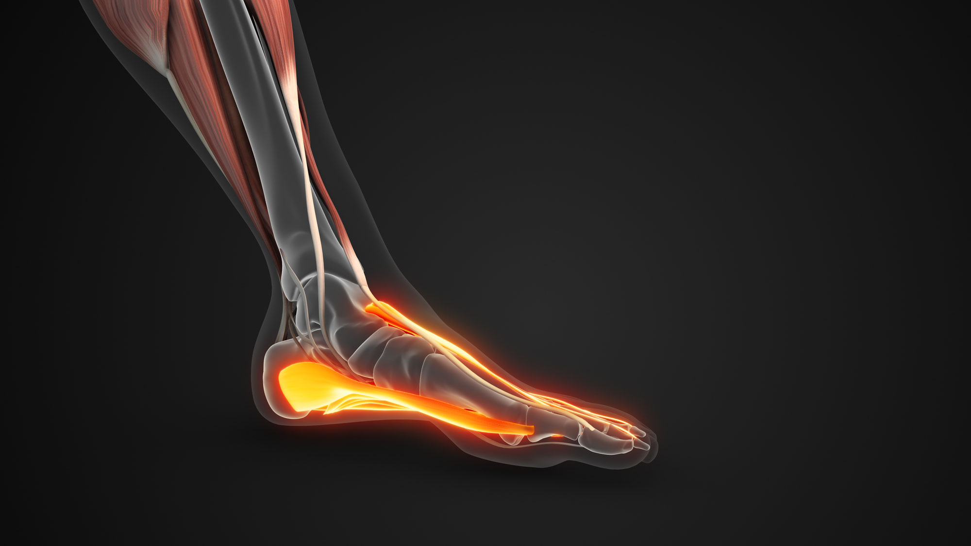 Fascitis plantar: una causa común de dolor en el talón y cómo tratarla con terapia de ondas de choque