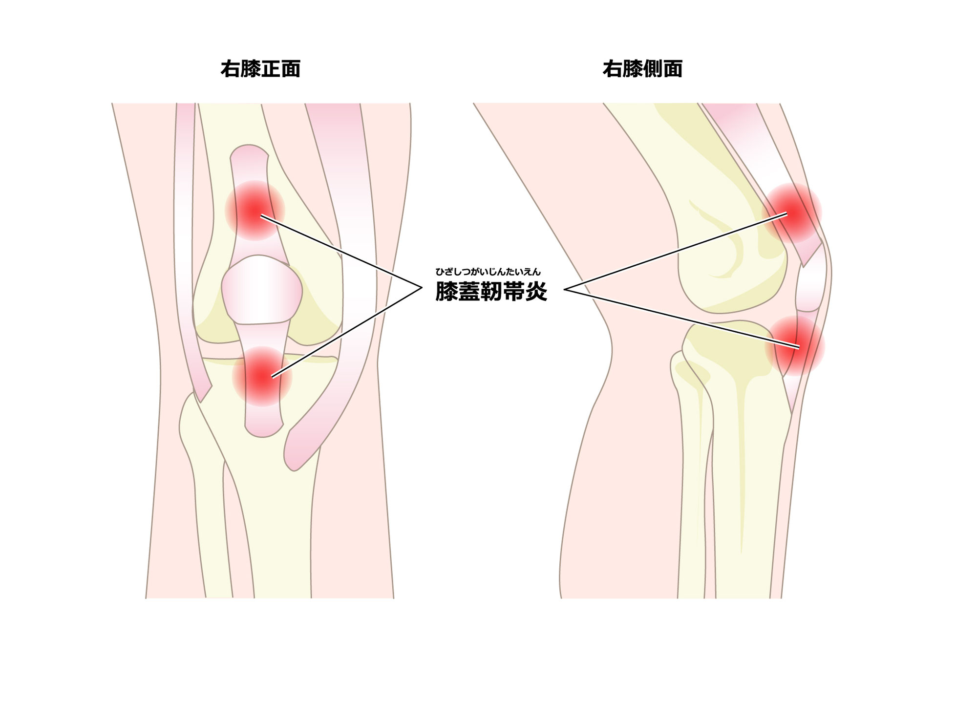 1分で分かる【膝】ジャンパー膝：膝蓋靭帯炎の原因と治し方｜着地動作について