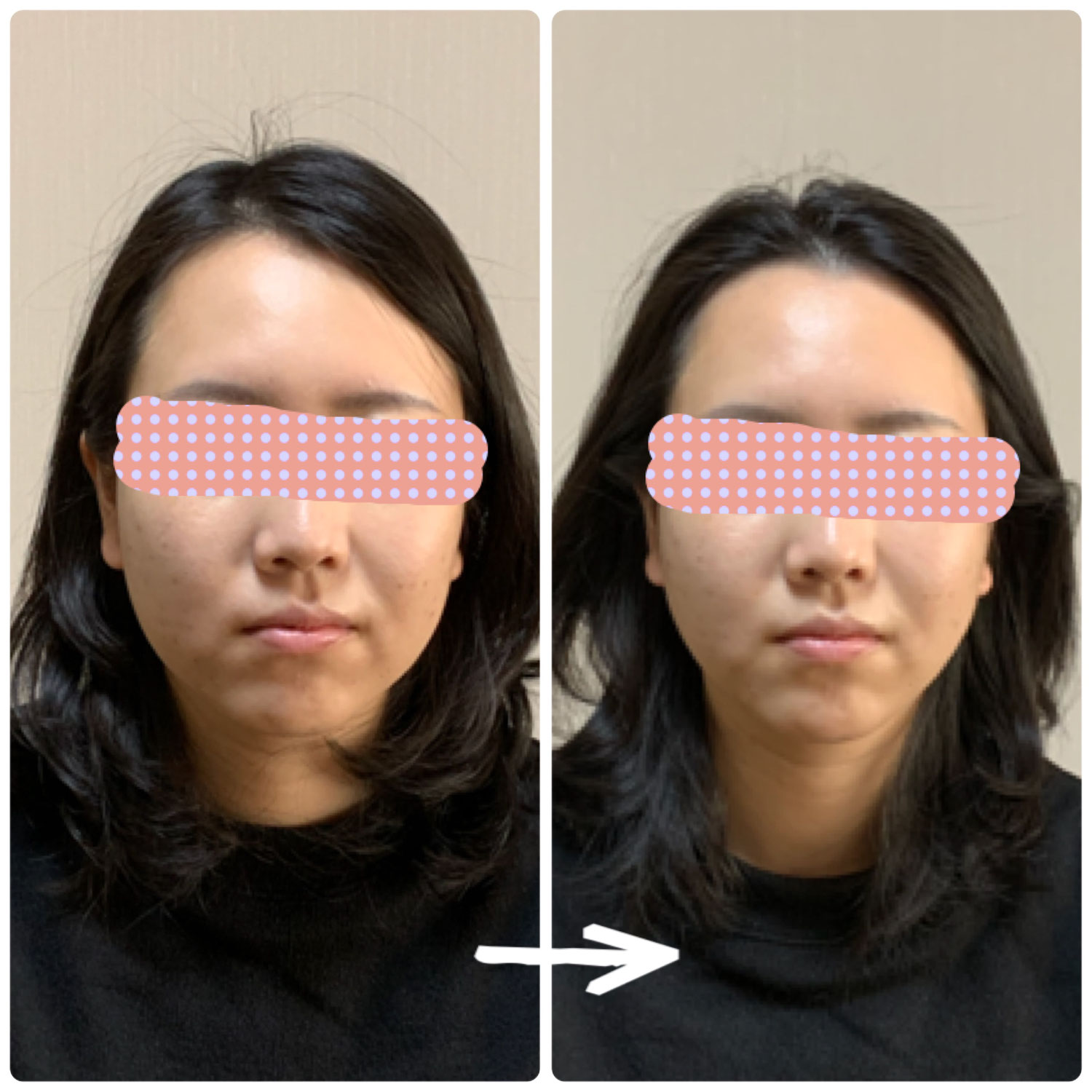 小顔さん♪ビフォーアフター