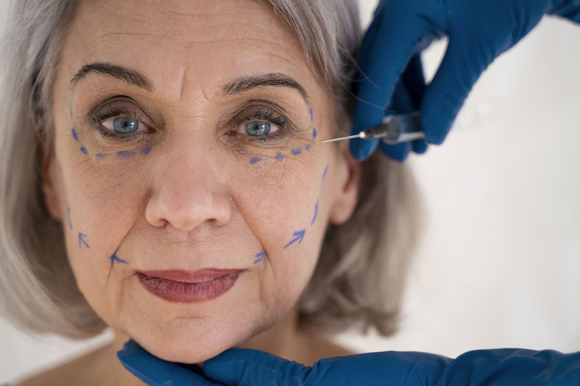 Botox Nähe Hürth – Wirkung, Risiken und warum Hautaufbau langfristig die bessere Strategie ist